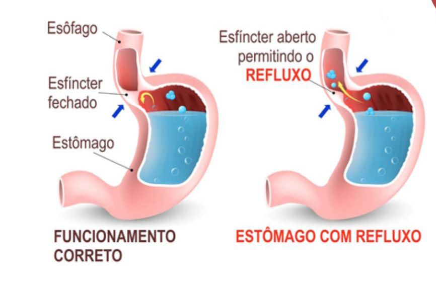 Refluxo Gastroesofágico e Alimentação: uma associação indispensável